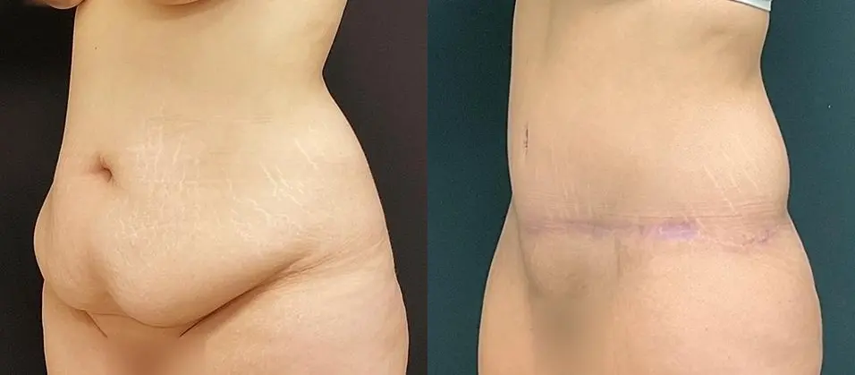 Tummy Tuck: Patient 17 - Before and After 2