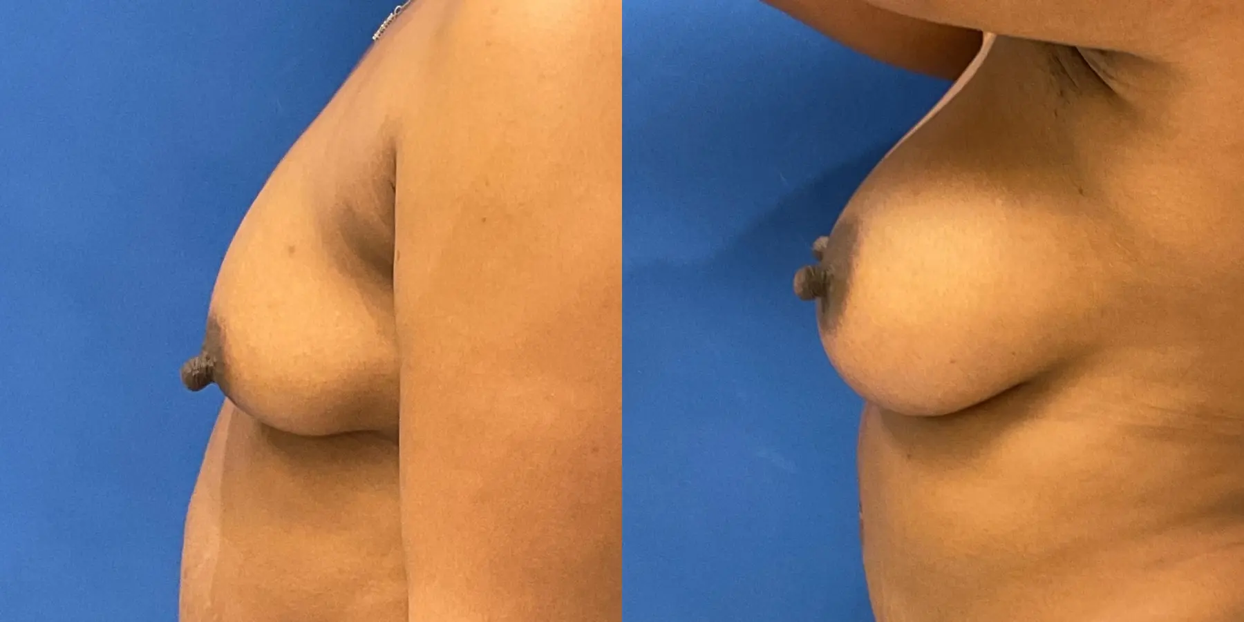 Breast Augmentation: Patient 3 - Before and After 4