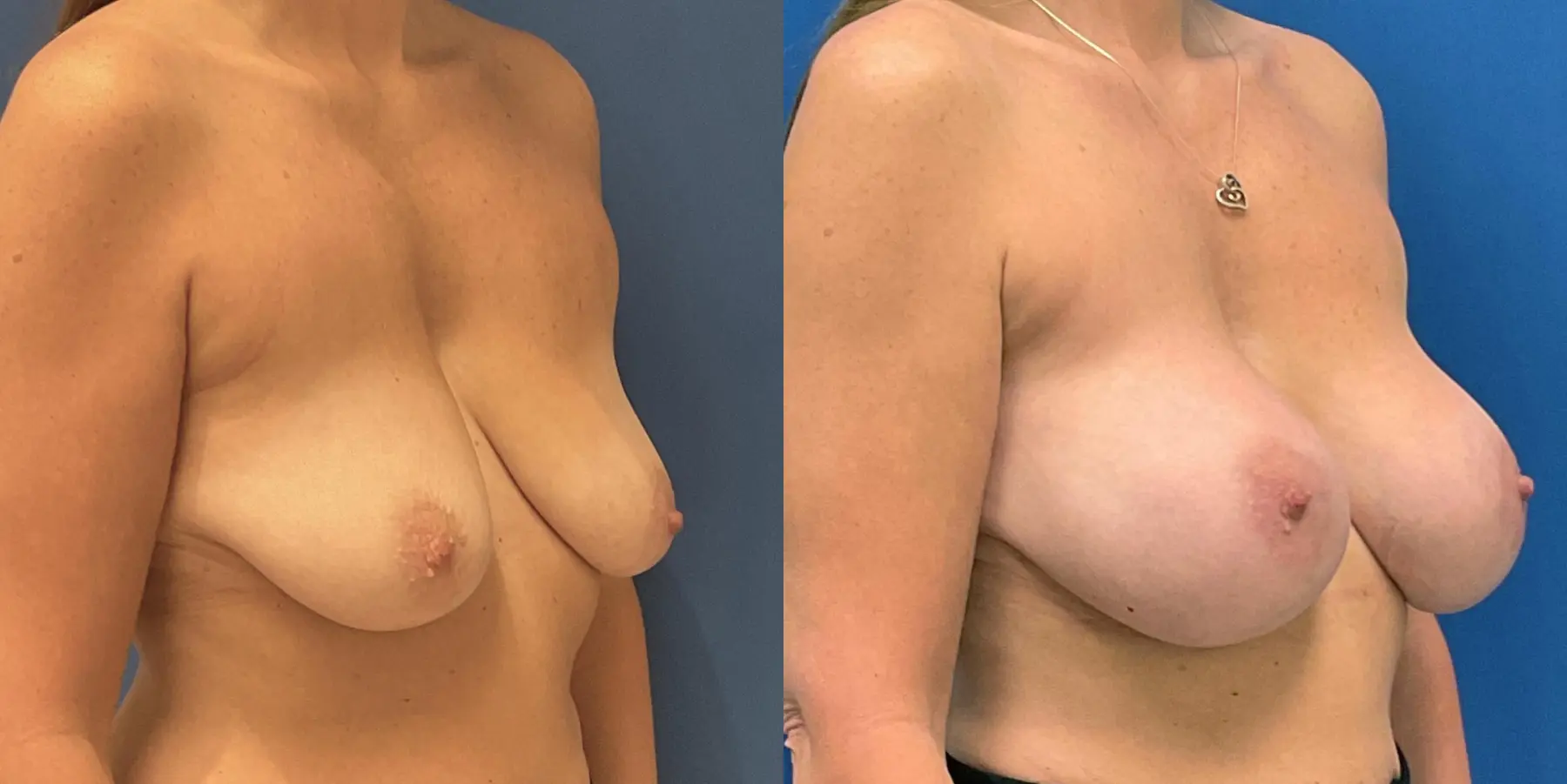 Breast Augmentation: Patient 9 - Before and After 3