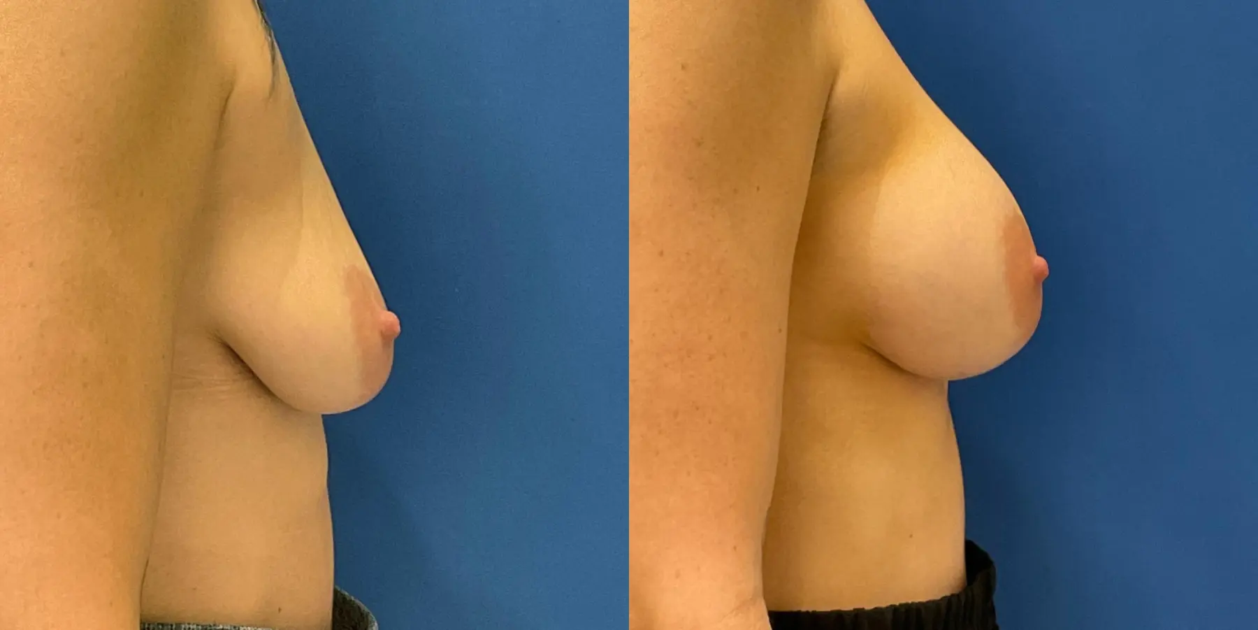 Breast Augmentation: Patient 2 - Before and After 5