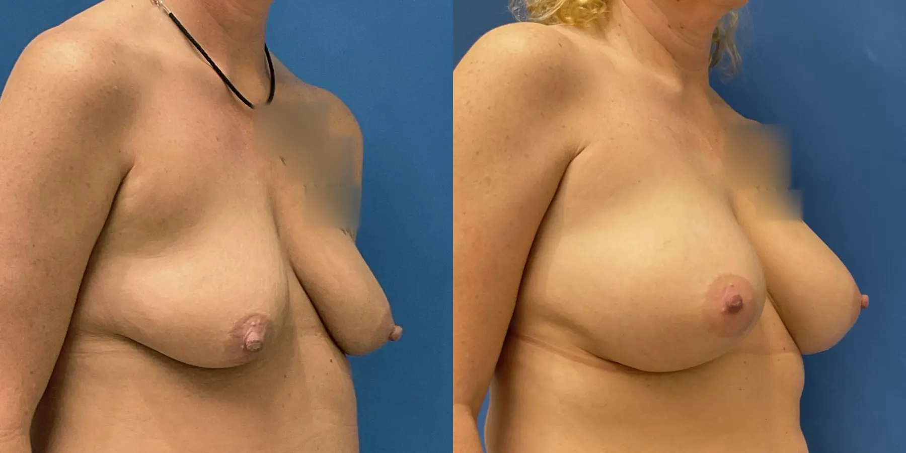 Breast Augmentation: Patient 4 - Before and After 3