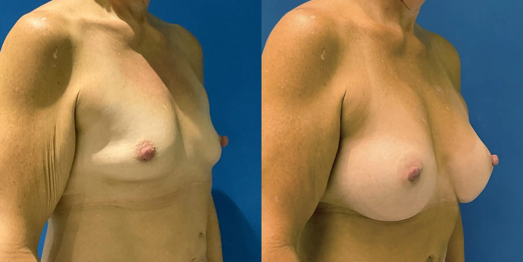 Breast Augmentation: Patient 5 - Before and After 3