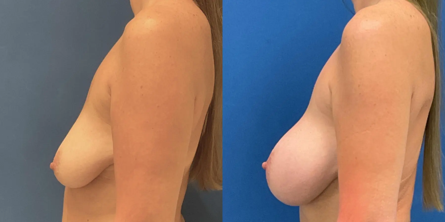 Breast Augmentation: Patient 9 - Before and After 4