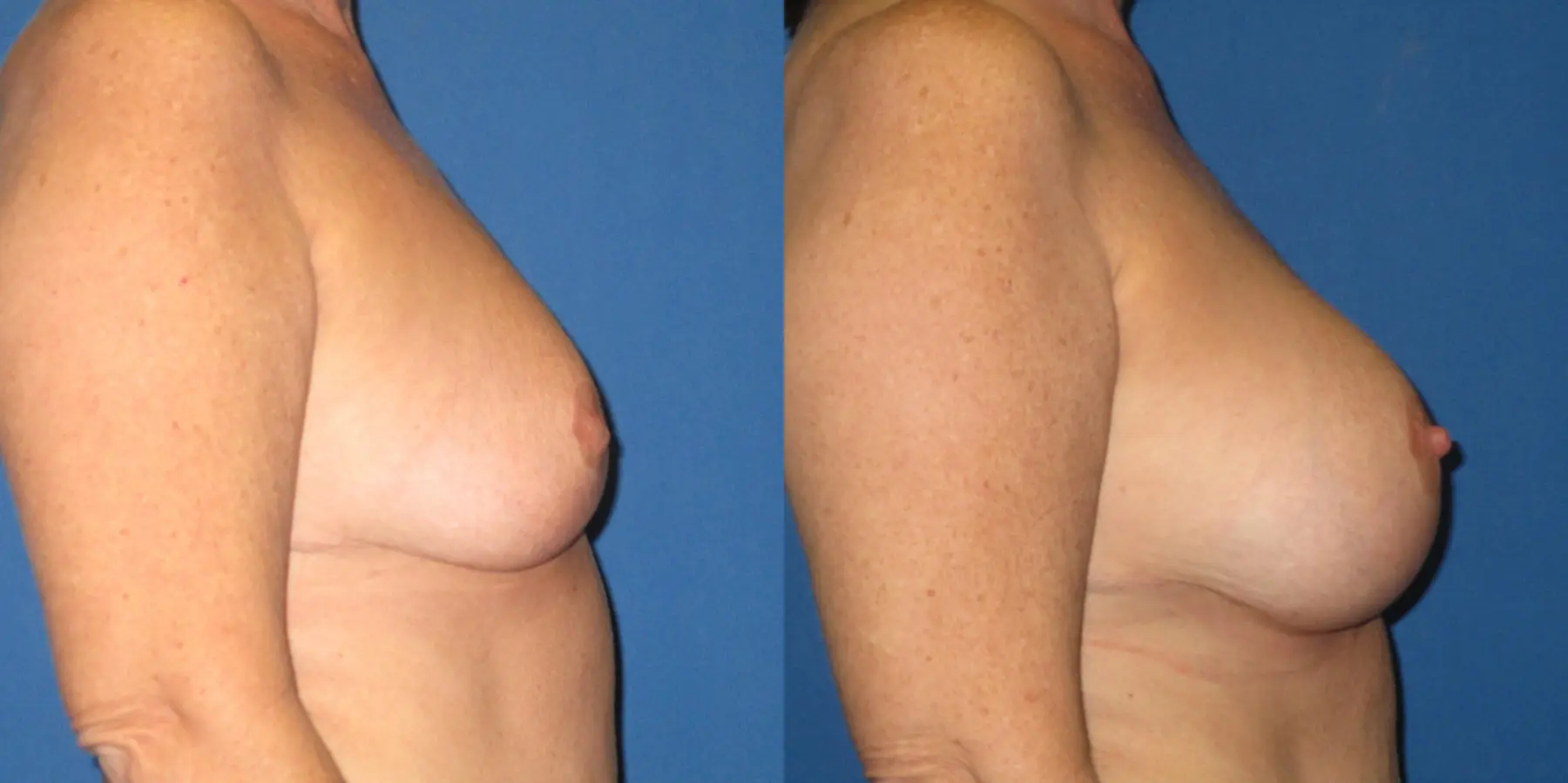 Breast Augmentation: Patient 10 - Before and After 3