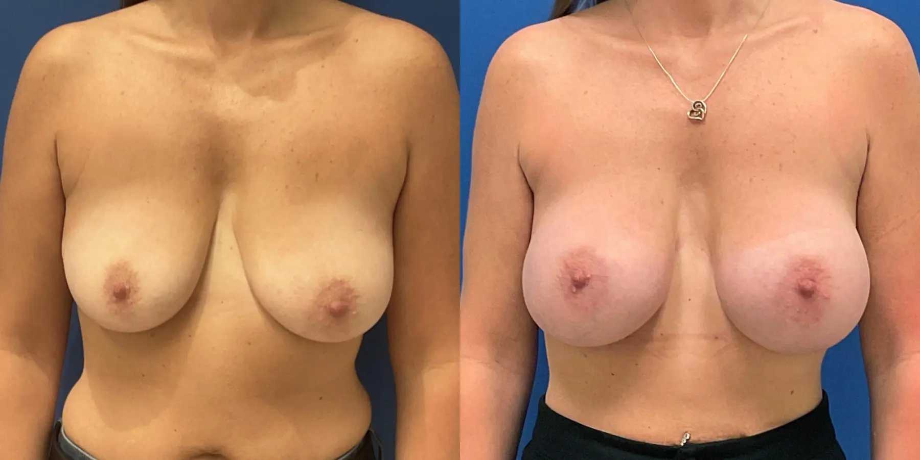 Breast Augmentation: Patient 9 - Before and After  