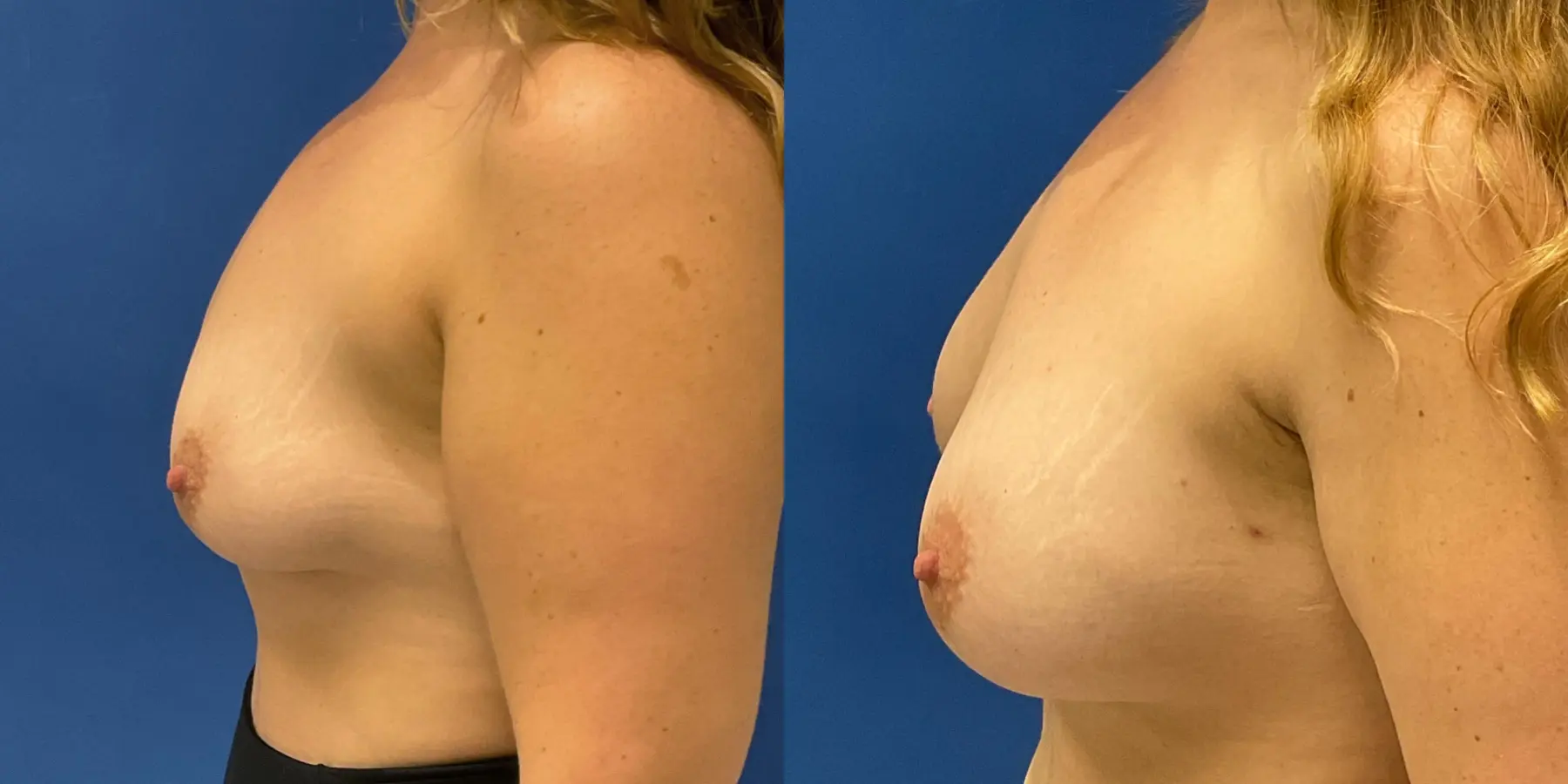 Breast Augmentation: Patient 7 - Before and After 4