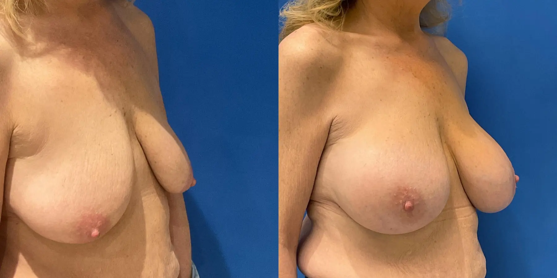 Breast Augmentation: Patient 8 - Before and After 3