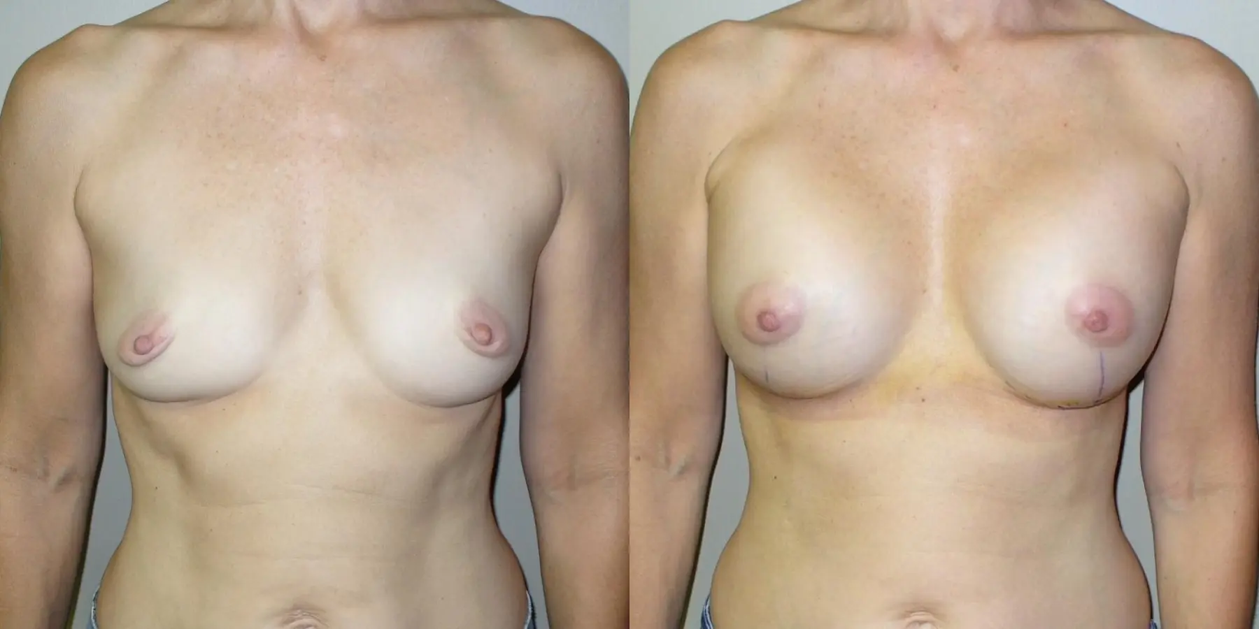 Breast Augmentation: Patient 13 - Before and After  