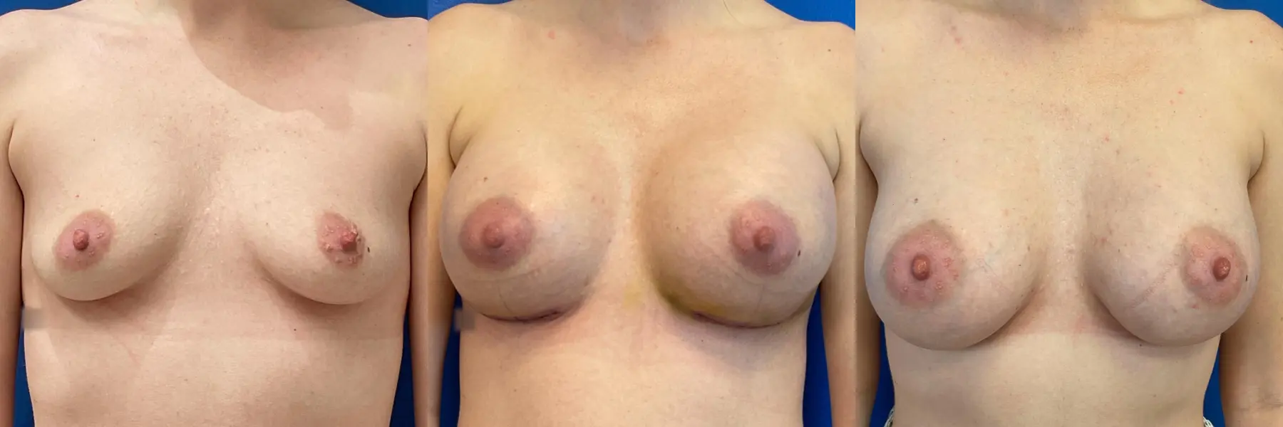 Breast Augmentation: Patient 11 - Before and After  