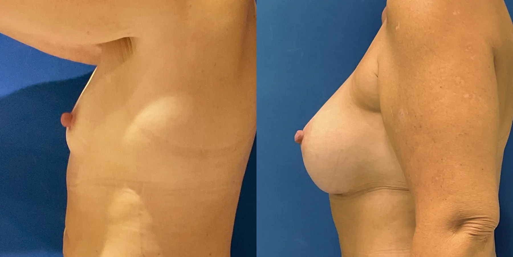 Breast Augmentation: Patient 5 - Before and After 4