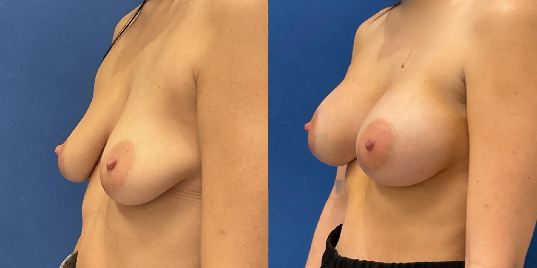 Breast Augmentation: Patient 2 - Before and After 2