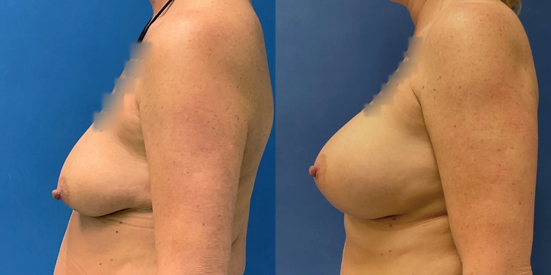 Breast Augmentation: Patient 4 - Before and After 4