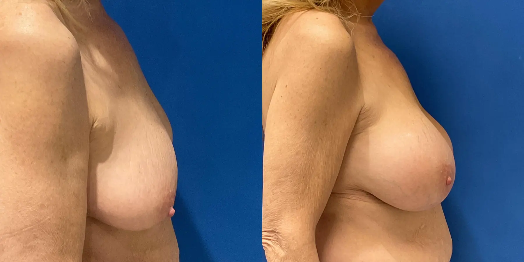 Breast Augmentation: Patient 8 - Before and After 5
