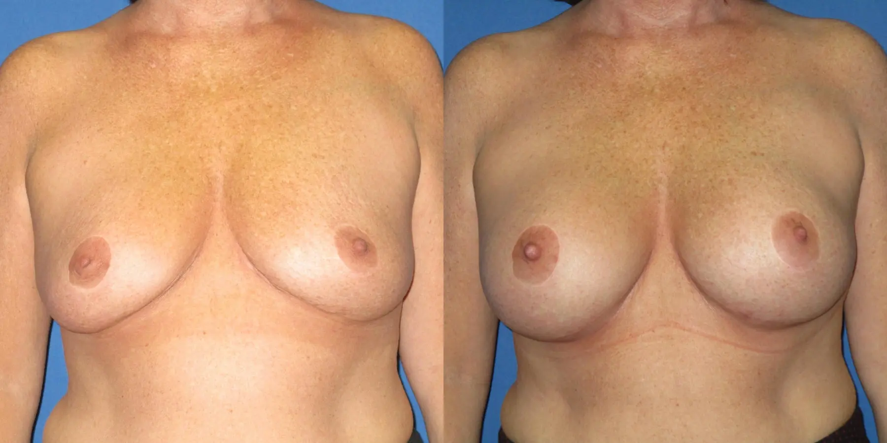 Breast Augmentation: Patient 10 - Before and After  