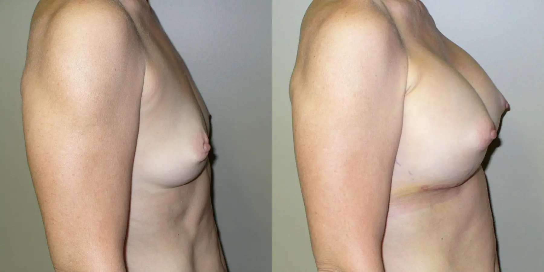 Breast Augmentation: Patient 13 - Before and After 3