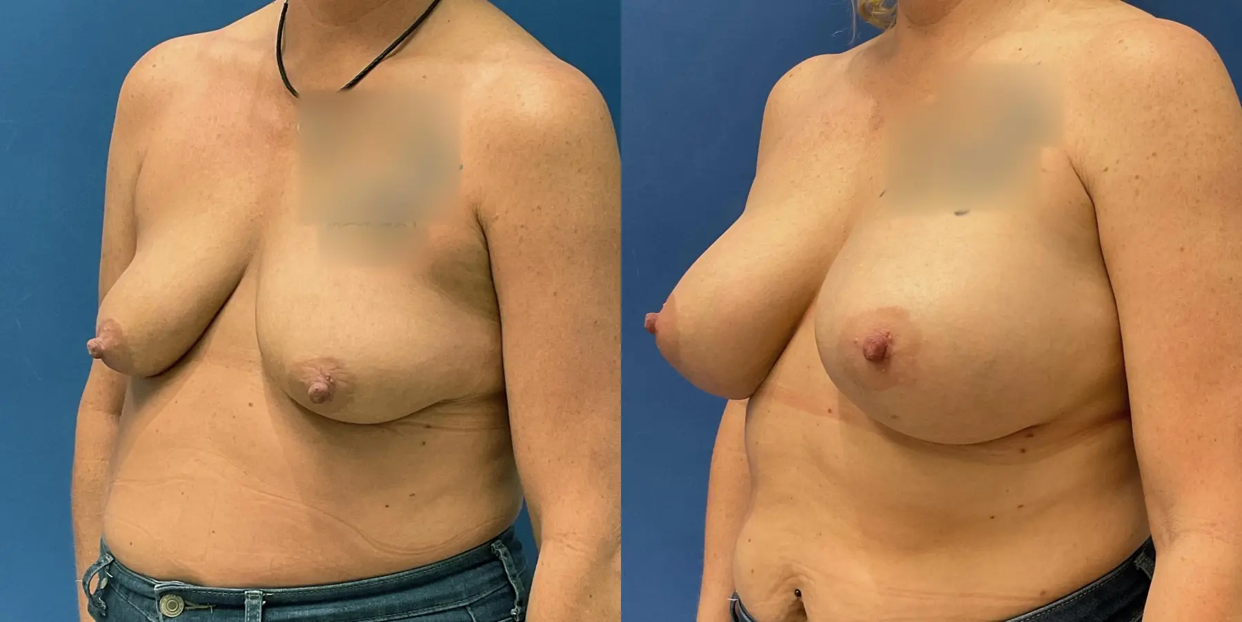 Breast Augmentation: Patient 4 - Before and After 2