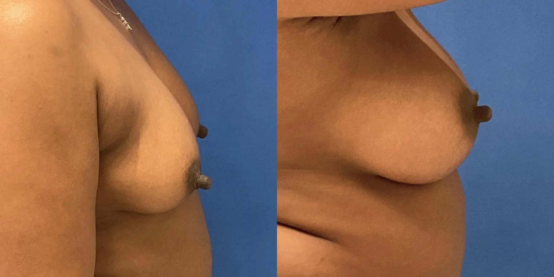 Breast Augmentation: Patient 3 - Before and After 5