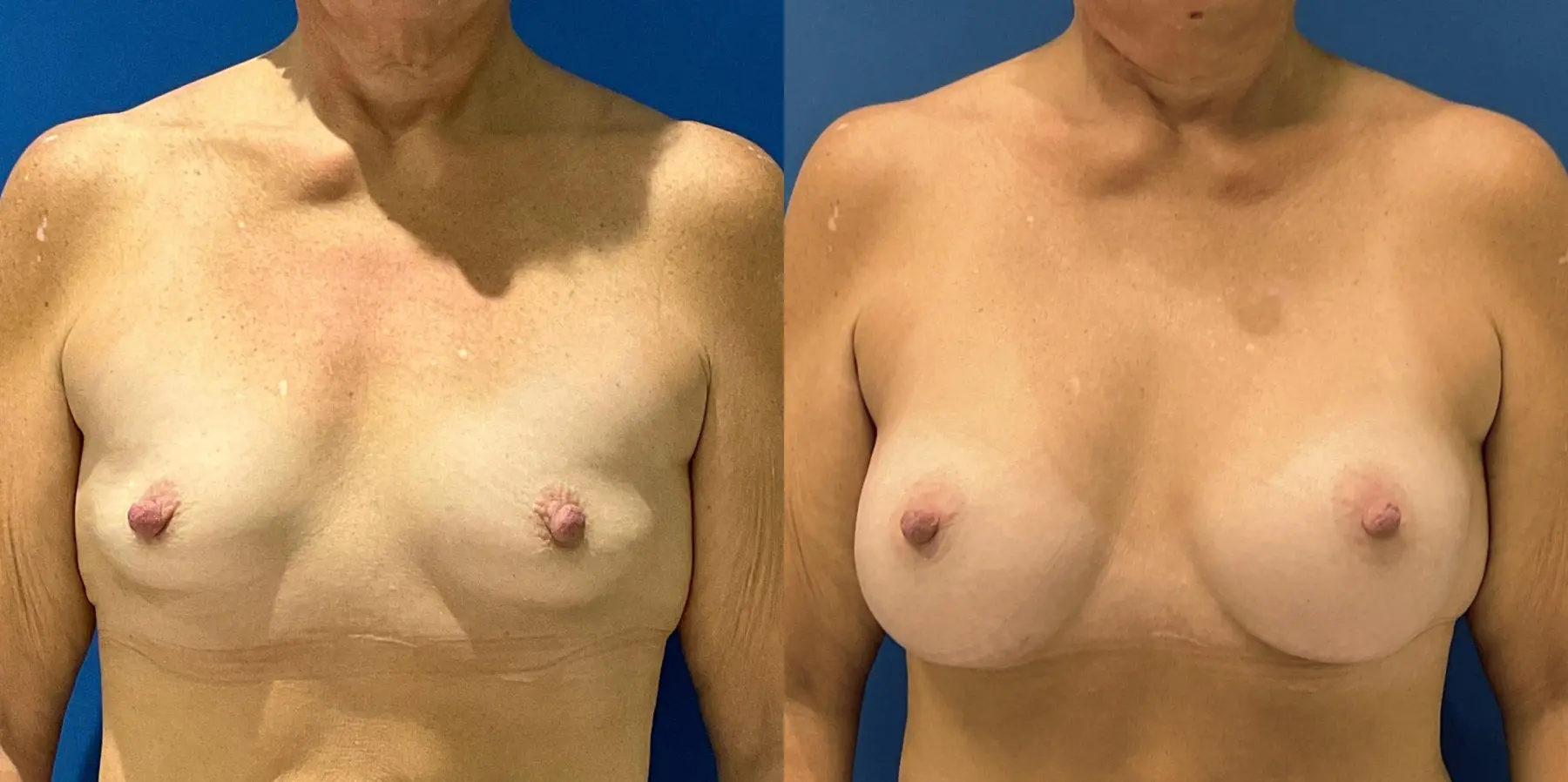 Breast Augmentation: Patient 5 - Before and After  