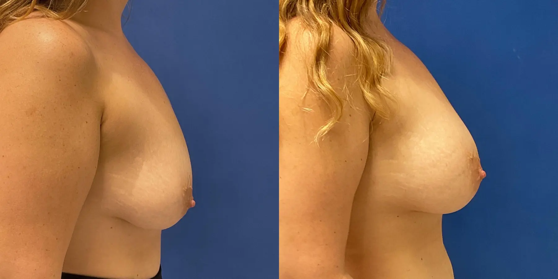 Breast Augmentation: Patient 7 - Before and After 5