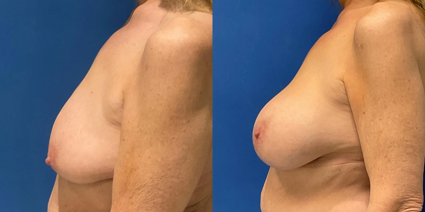Breast Augmentation: Patient 8 - Before and After 4