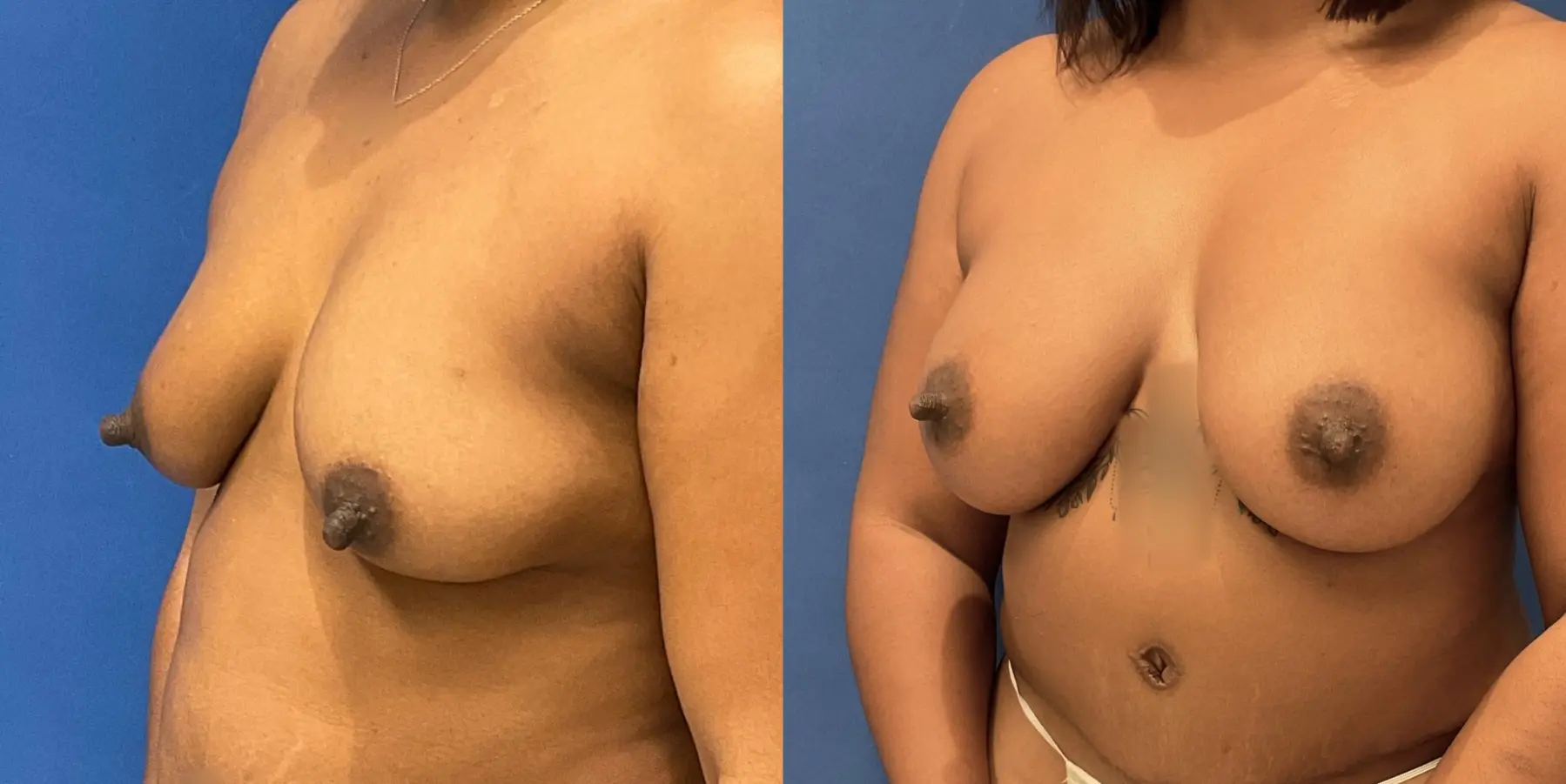 Breast Augmentation: Patient 3 - Before and After 2