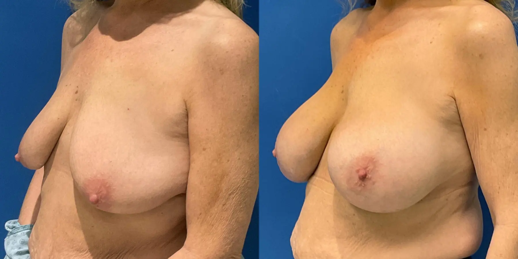 Breast Augmentation: Patient 8 - Before and After 2