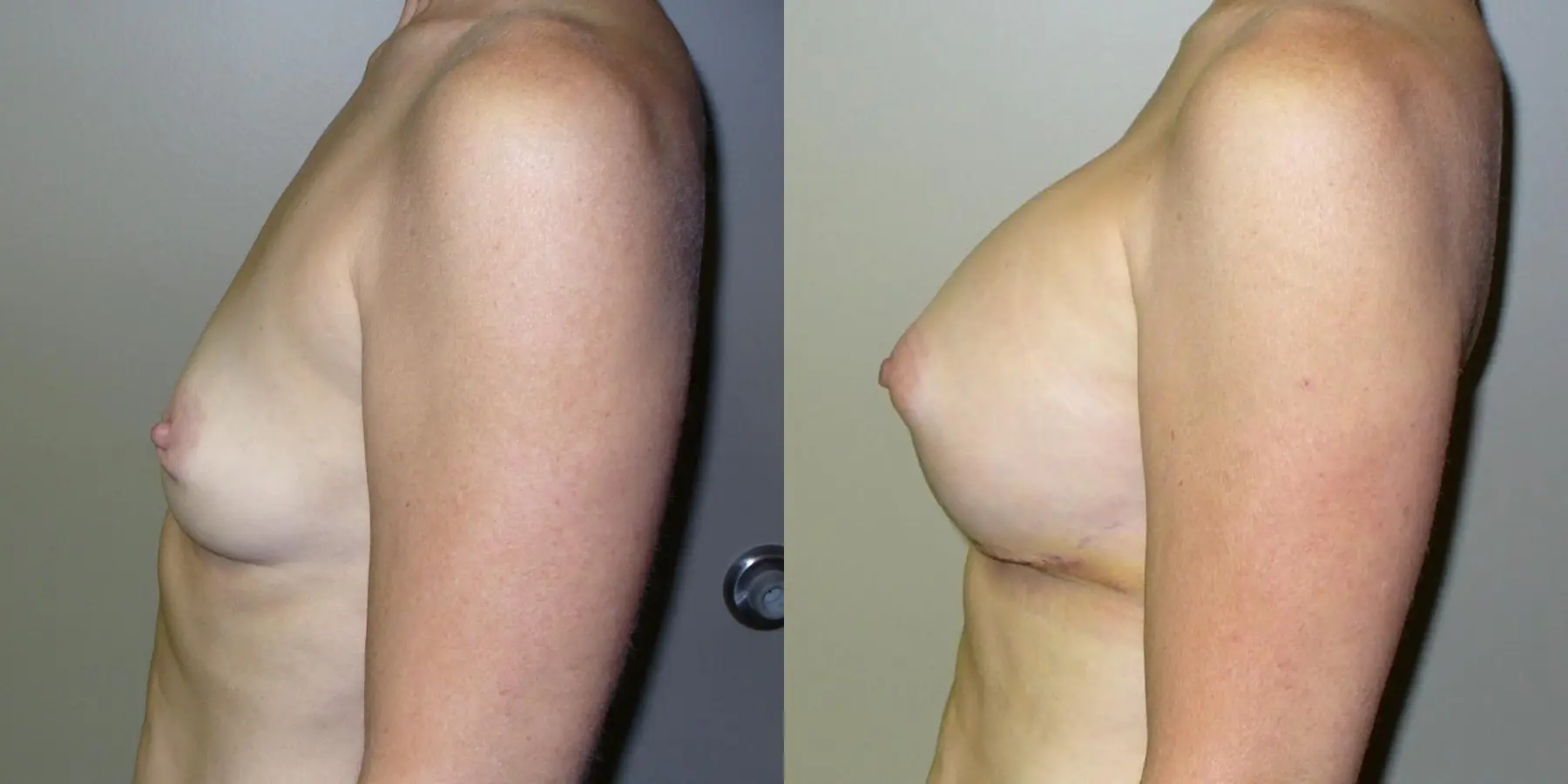 Breast Augmentation: Patient 13 - Before and After 2