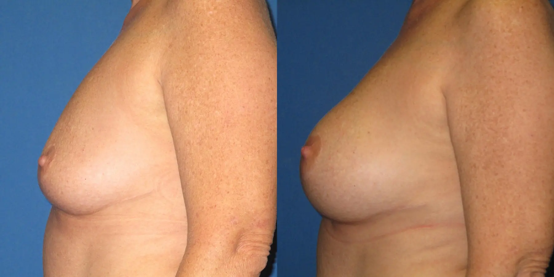 Breast Augmentation: Patient 10 - Before and After 2