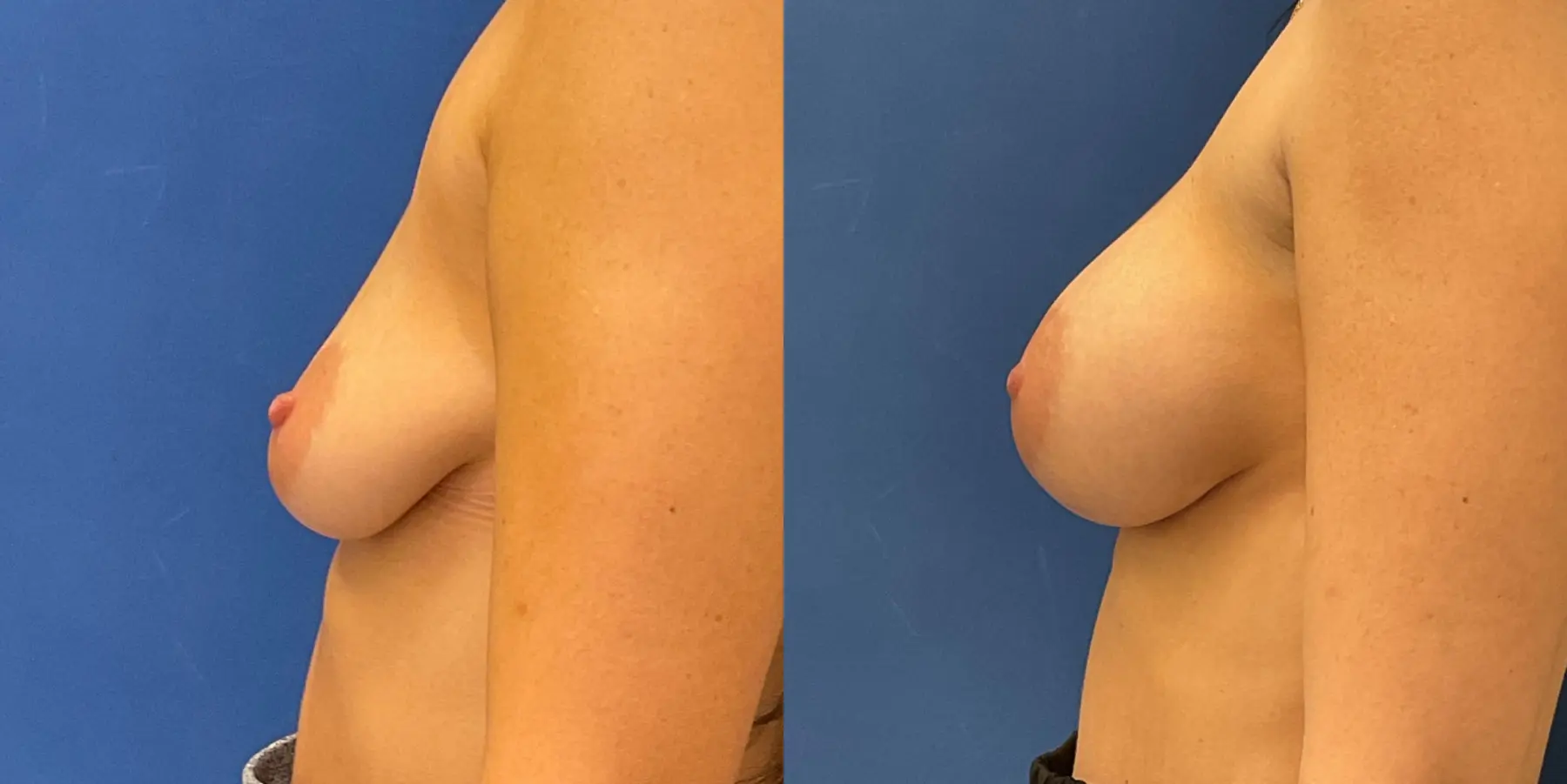 Breast Augmentation: Patient 2 - Before and After 4