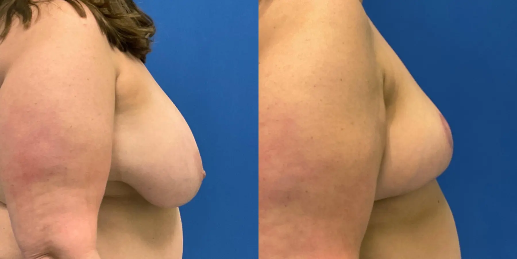 Breast Reduction: Patient 8 - Before and After 4