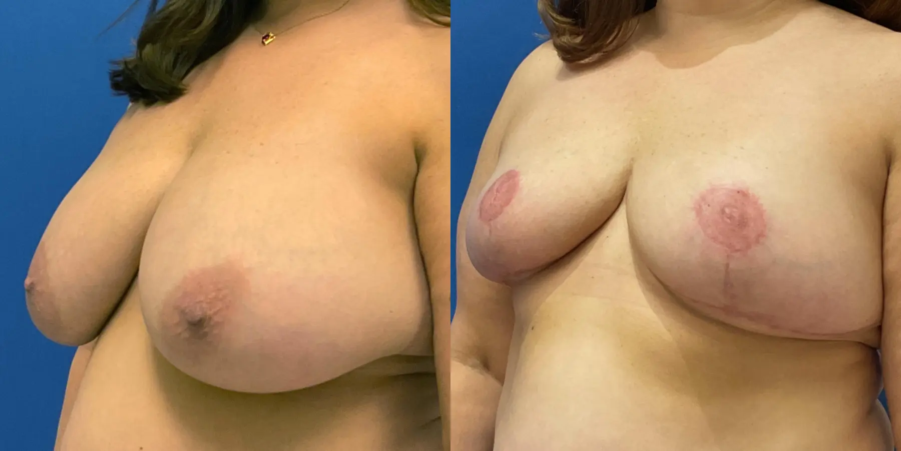 Breast Reduction: Patient 8 - Before and After 3