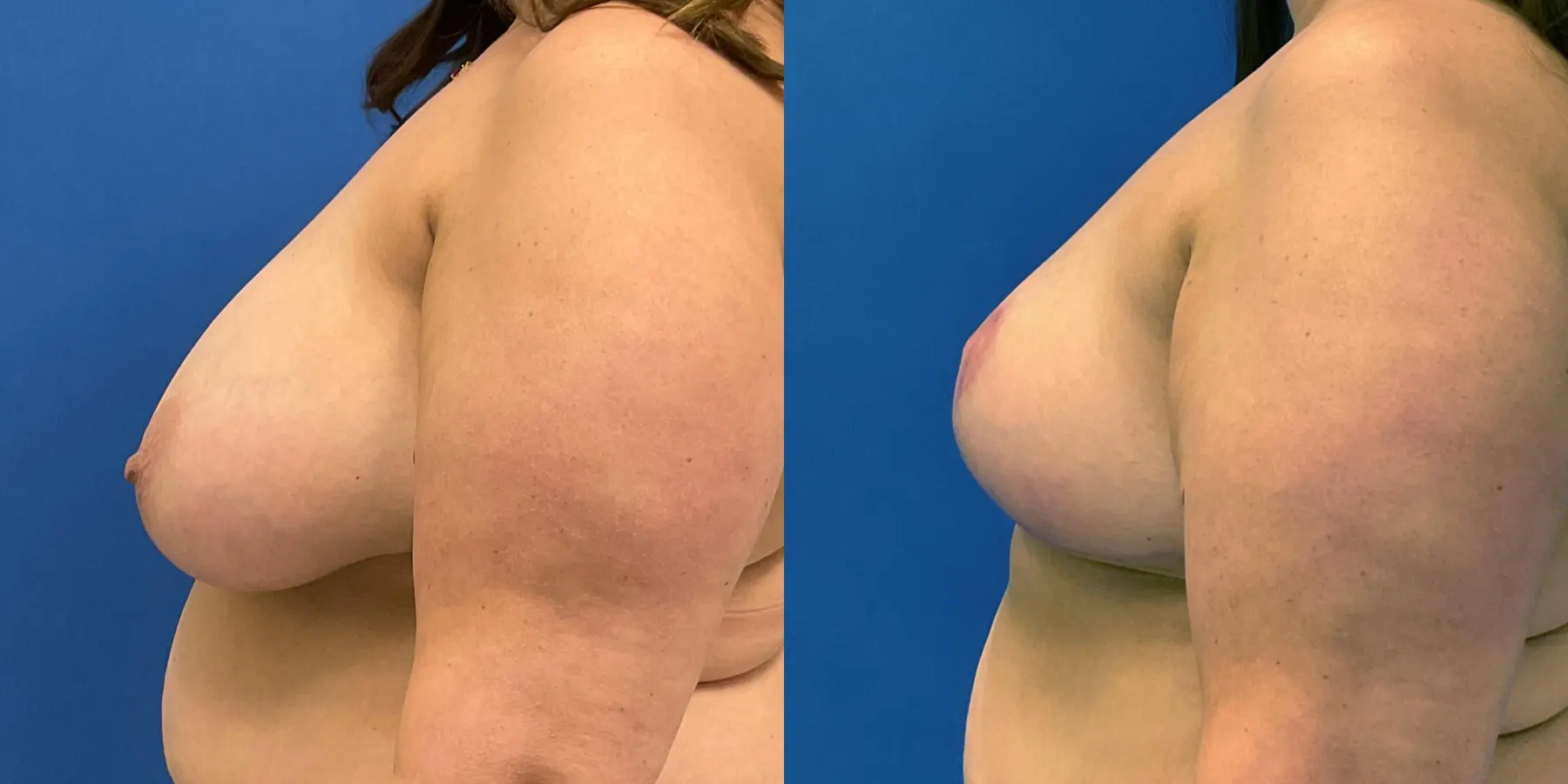 Breast Reduction: Patient 8 - Before and After 5