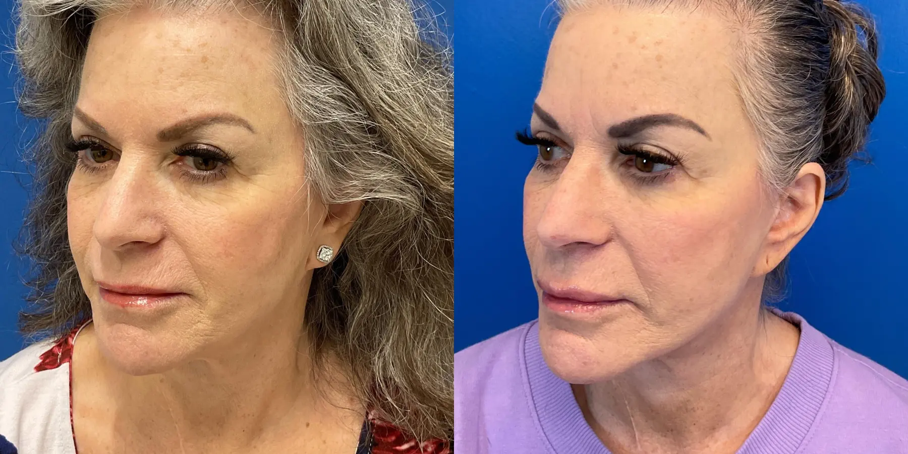 Facelift: Patient 6 - Before and After 4