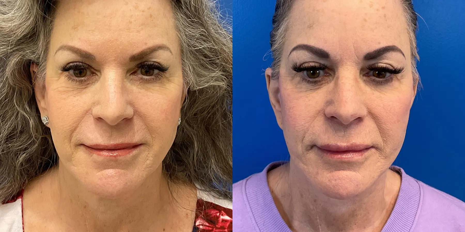 Facelift: Patient 6 - Before and After 3