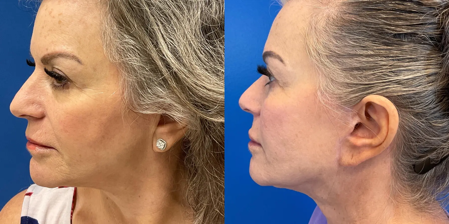 Facelift: Patient 6 - Before and After 5