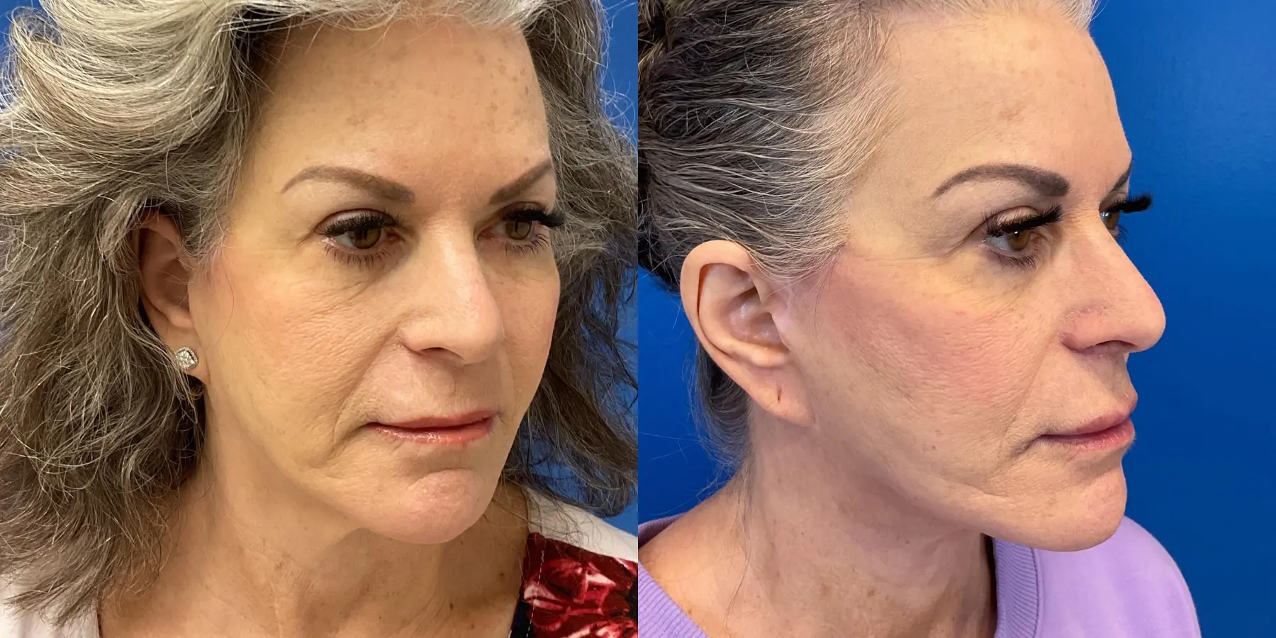 Facelift: Patient 6 - Before and After 2