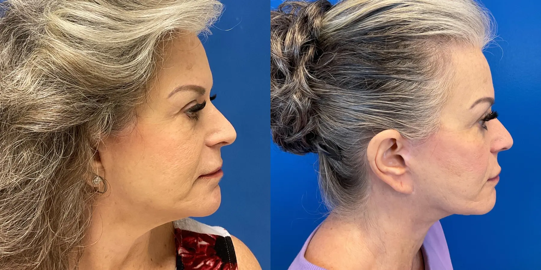 Facelift: Patient 6 - Before and After  