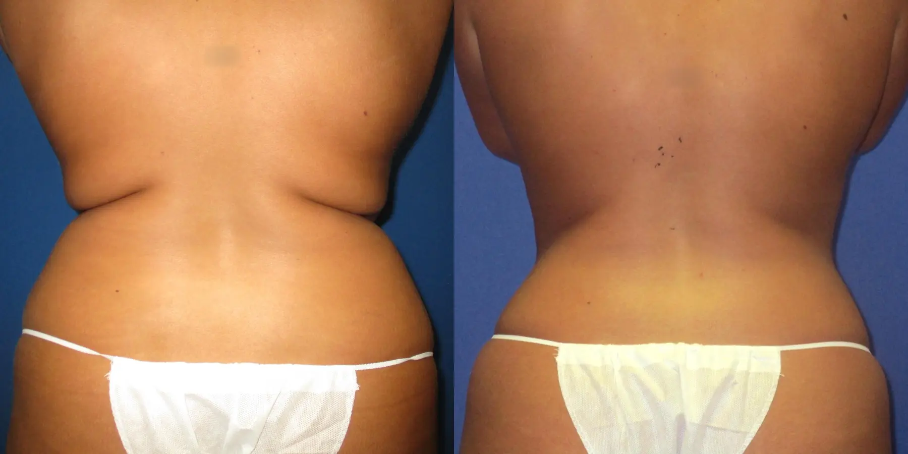 Liposuction: Patient 15 - Before and After 4