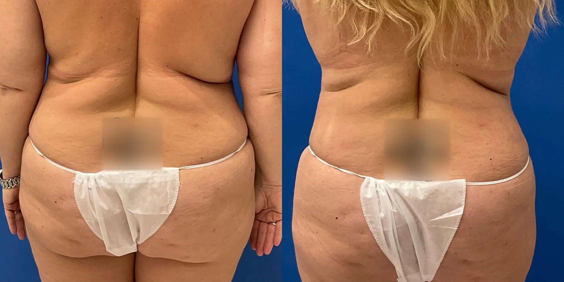 Liposuction: Patient 7 - Before and After 6