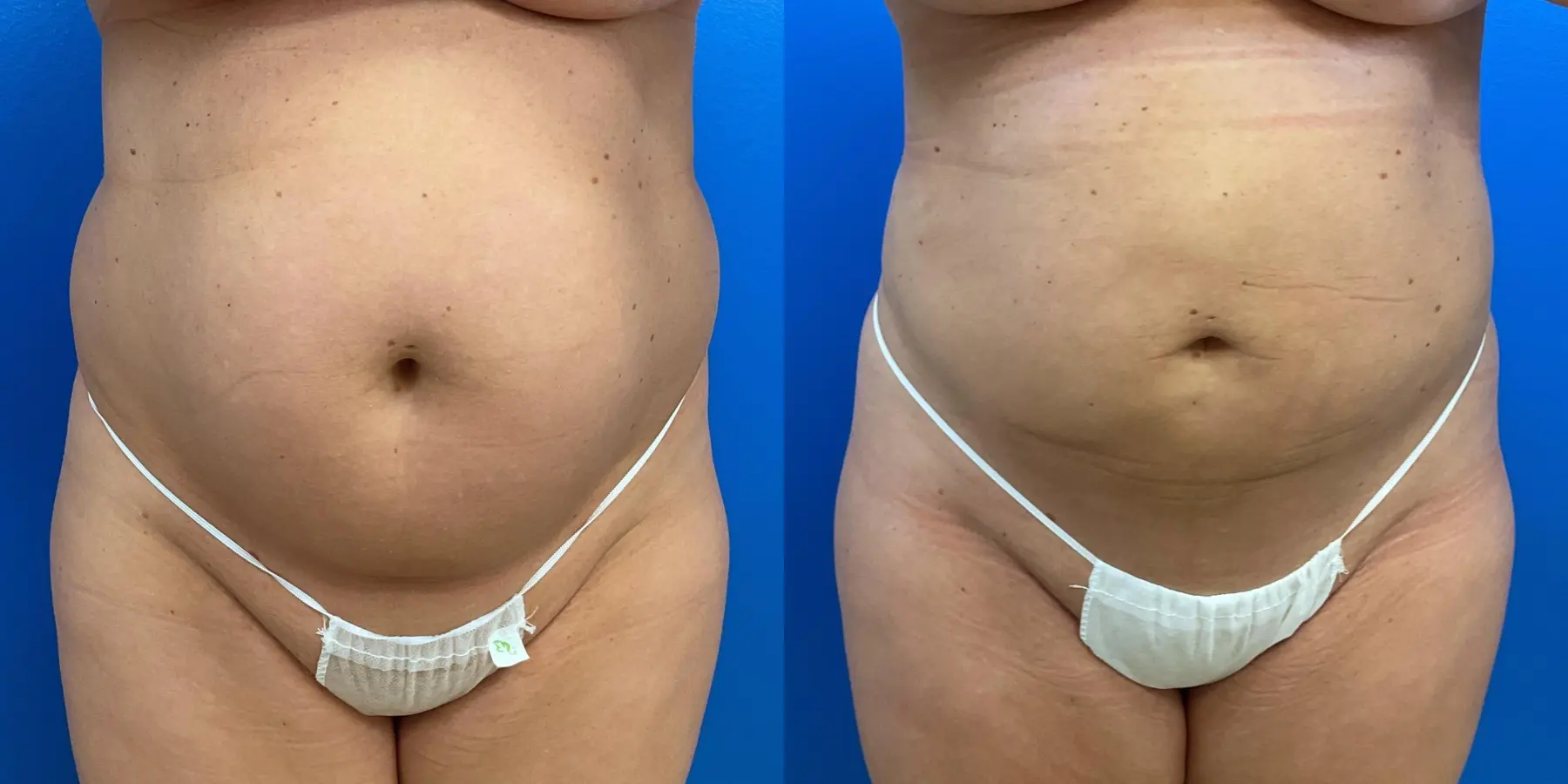 Before and after a liposuction. - Before and After