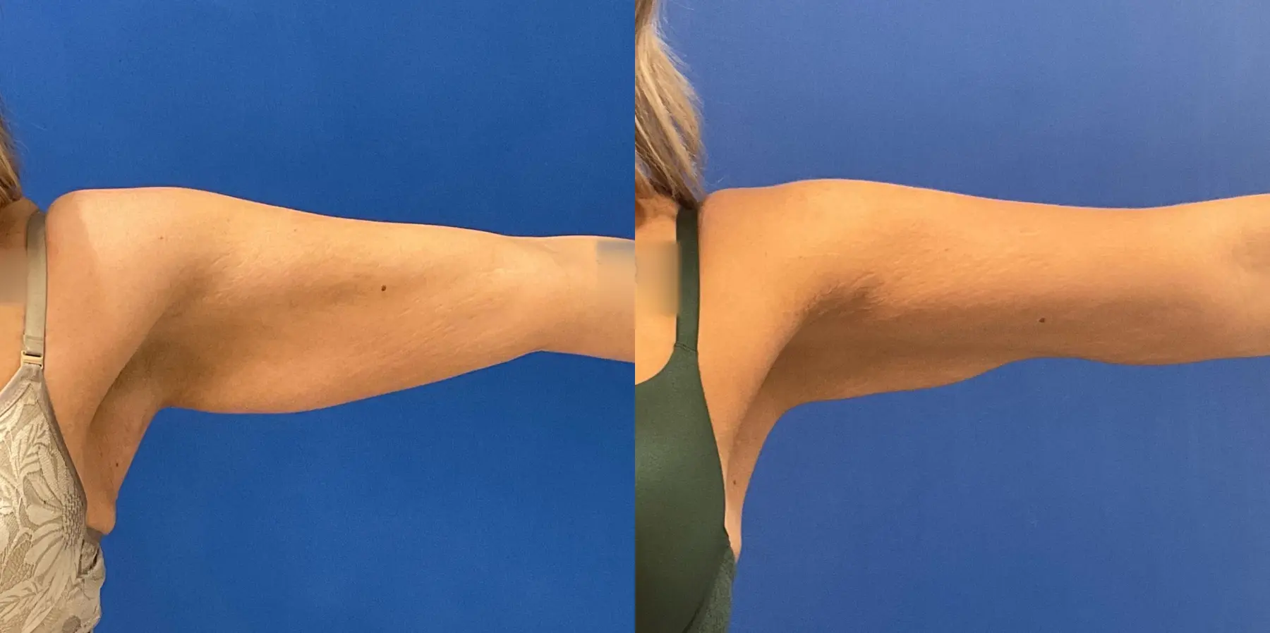 Liposuction: Patient 12 - Before and After  