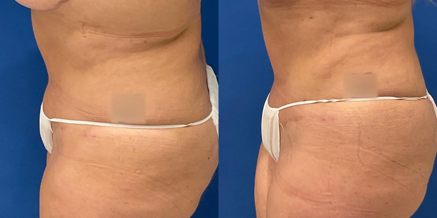 Liposuction: Patient 7 - Before and After 4