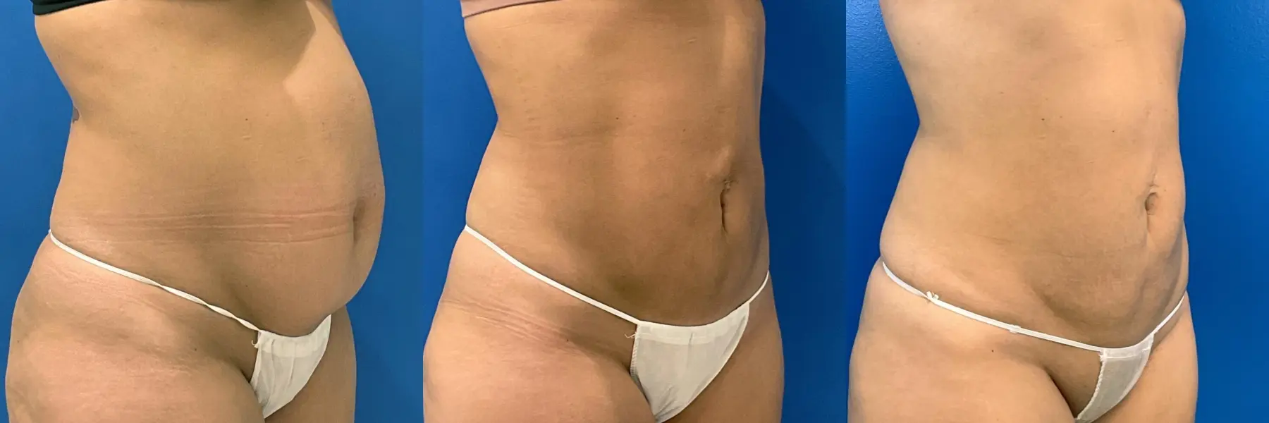 Liposuction: Patient 19 - Before and After 3