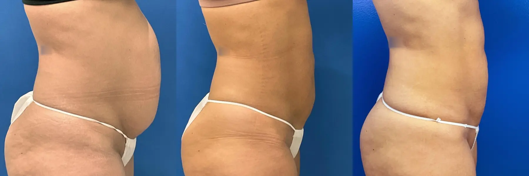 Liposuction: Patient 19 - Before and After 5