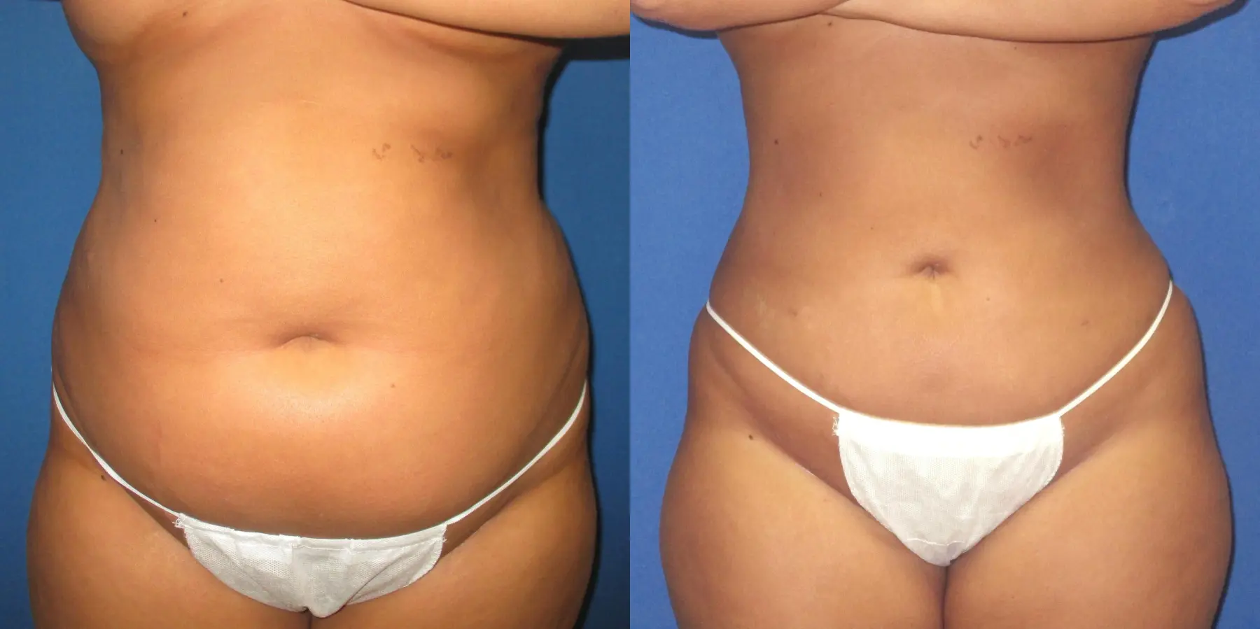 Liposuction: Patient 8 - Before and After  
