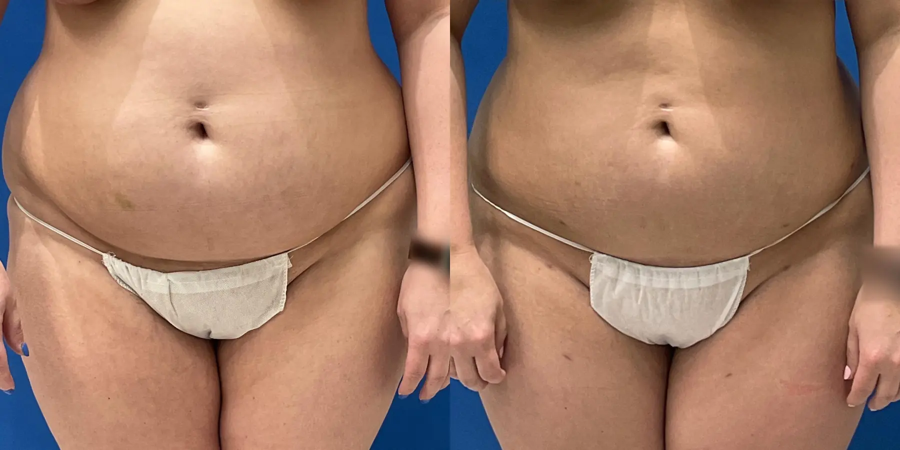 Before and after a liposuction. - Before and After