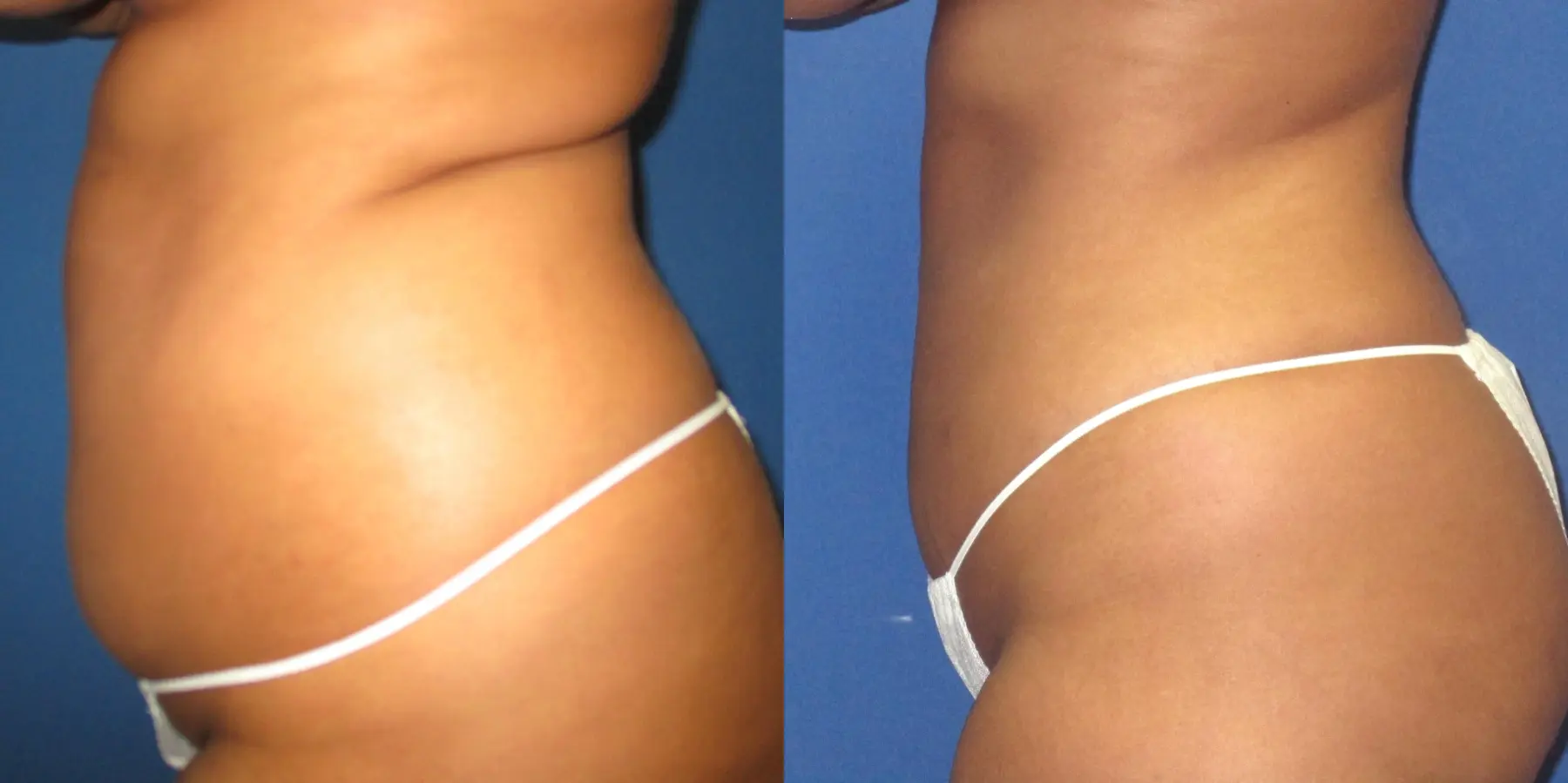 Liposuction: Patient 15 - Before and After 2