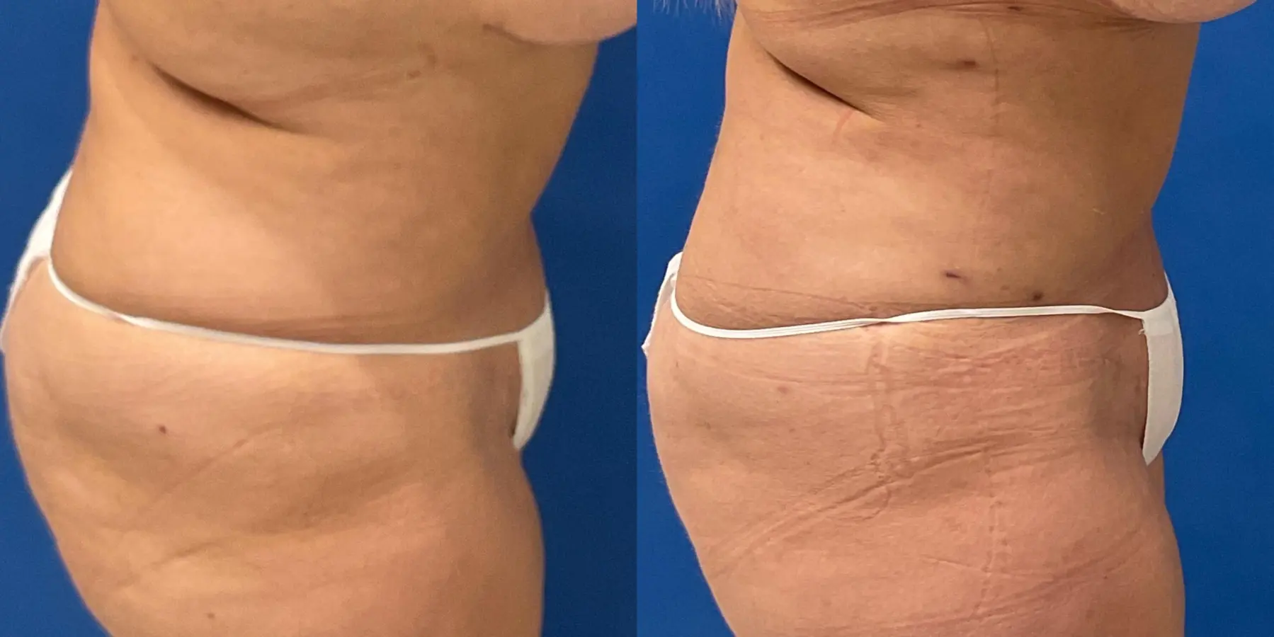 Liposuction: Patient 7 - Before and After 5