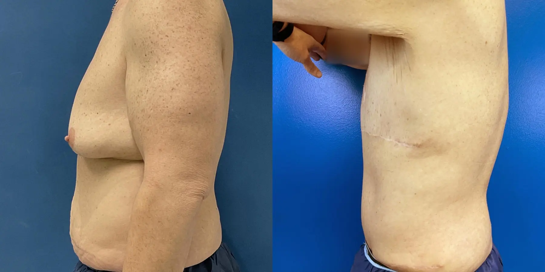 Male Breast Reduction: Patient 6 - Before and After 4