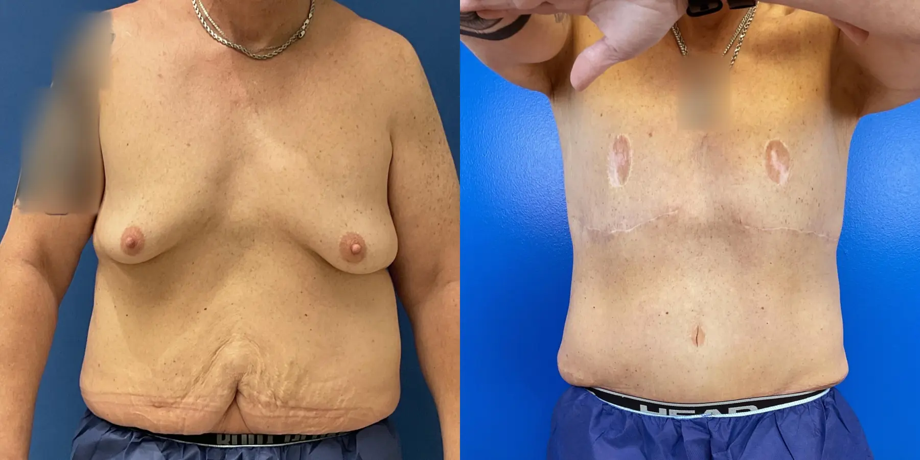 Male Breast Reduction: Patient 6 - Before and After 1